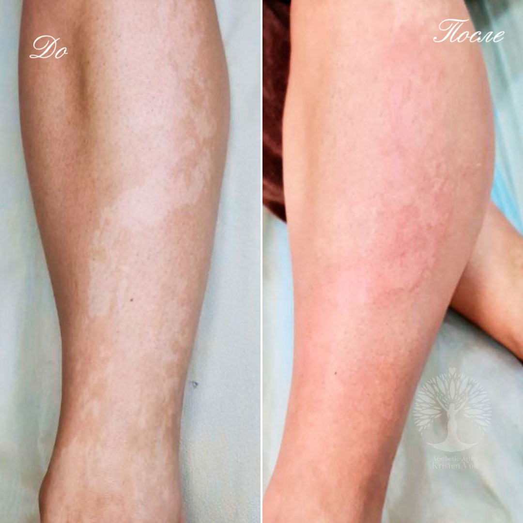 камуфляж шрамов, камуфляж рубцов +и шрамов