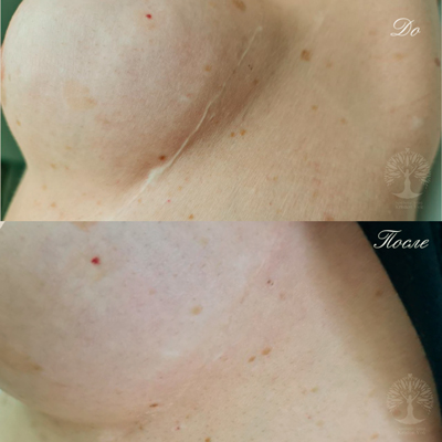 камуфляж шрамов, камуфляж рубцов +и шрамов