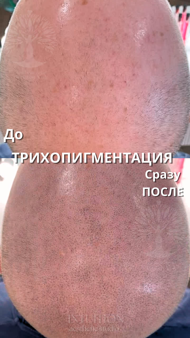 трихопигментация волос в Минске