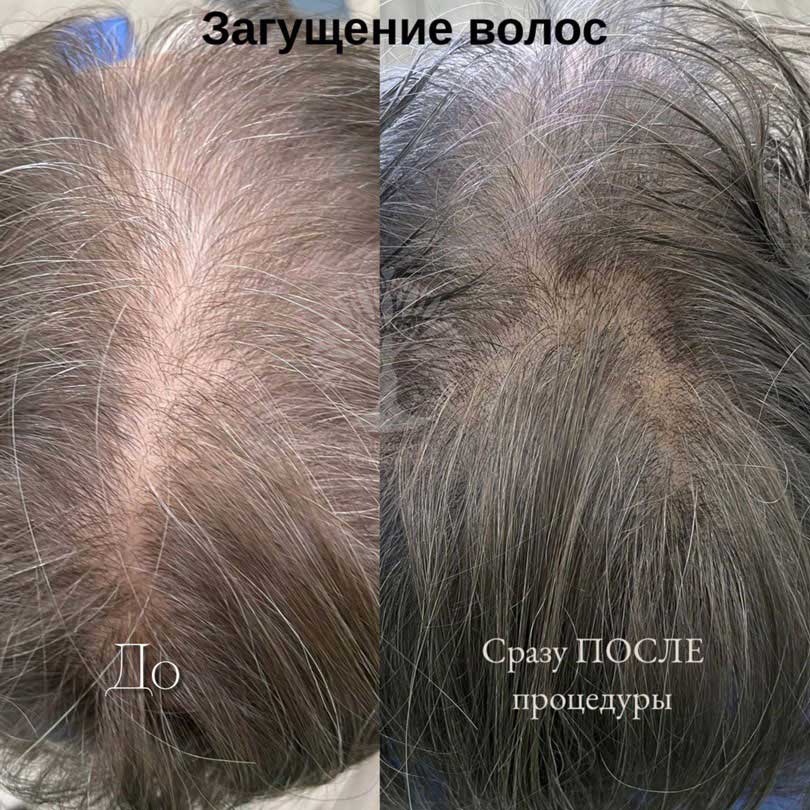 трихопигментация волос в Минске