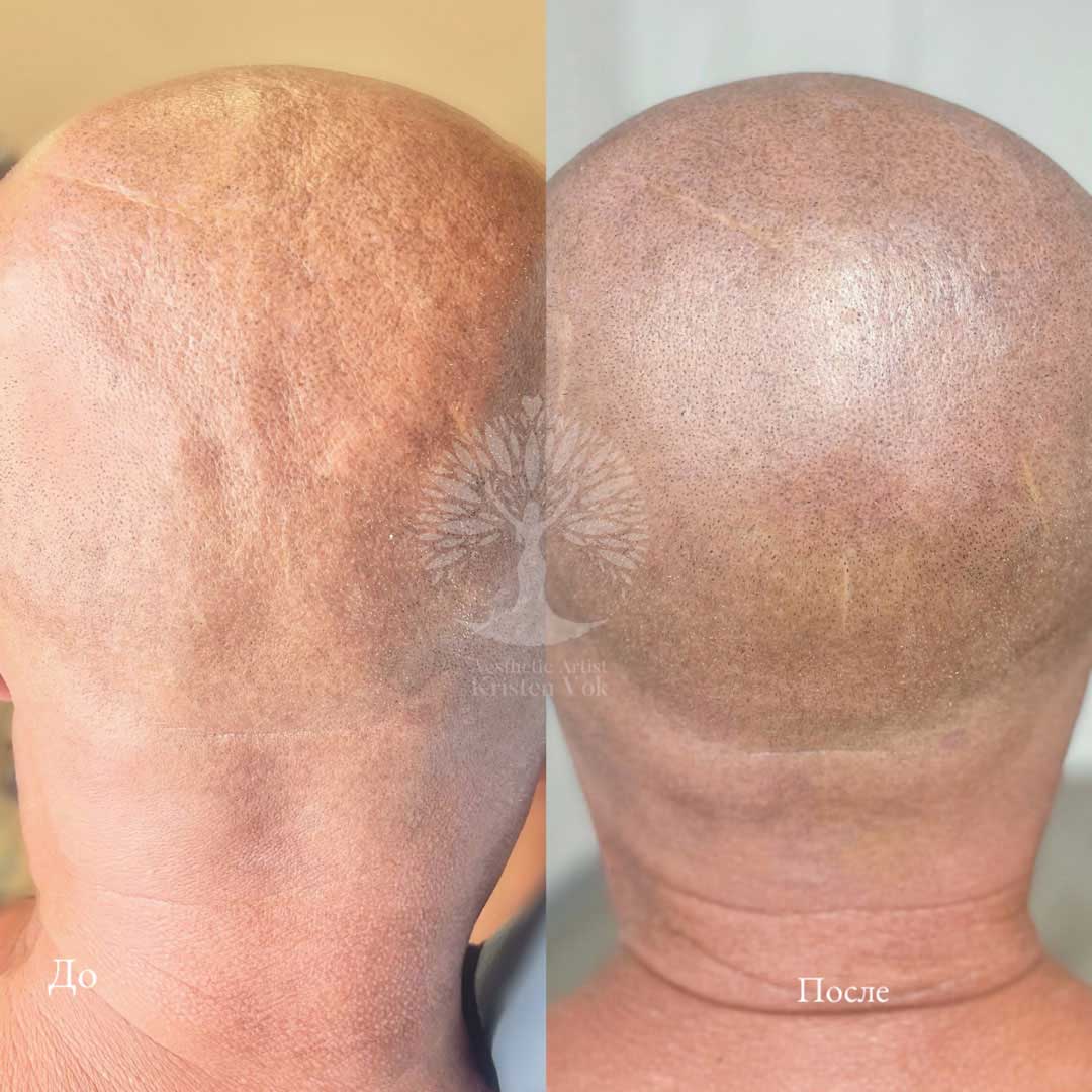 трихопигментация волос в Минске