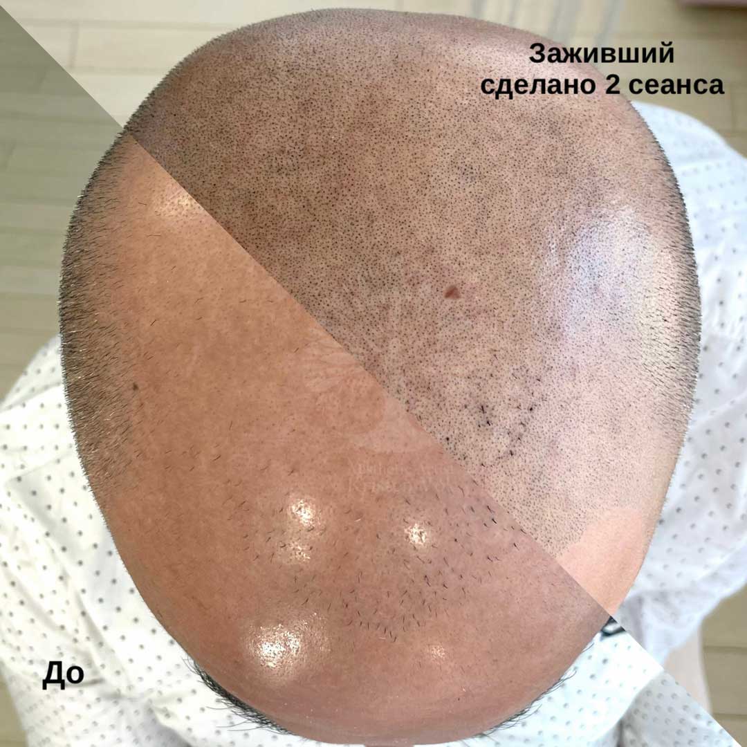 трихопигментация волос в Минске