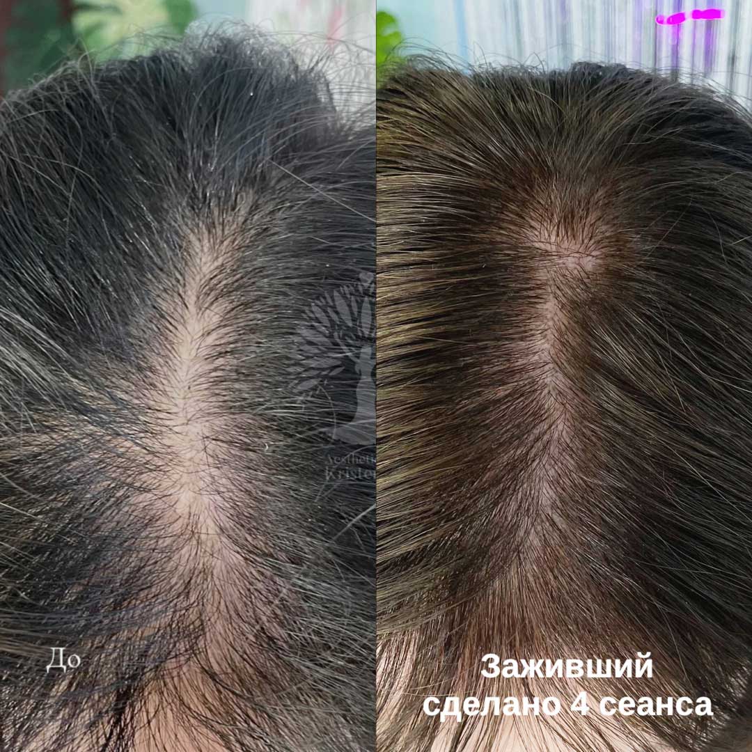 трихопигментация волос в Минске