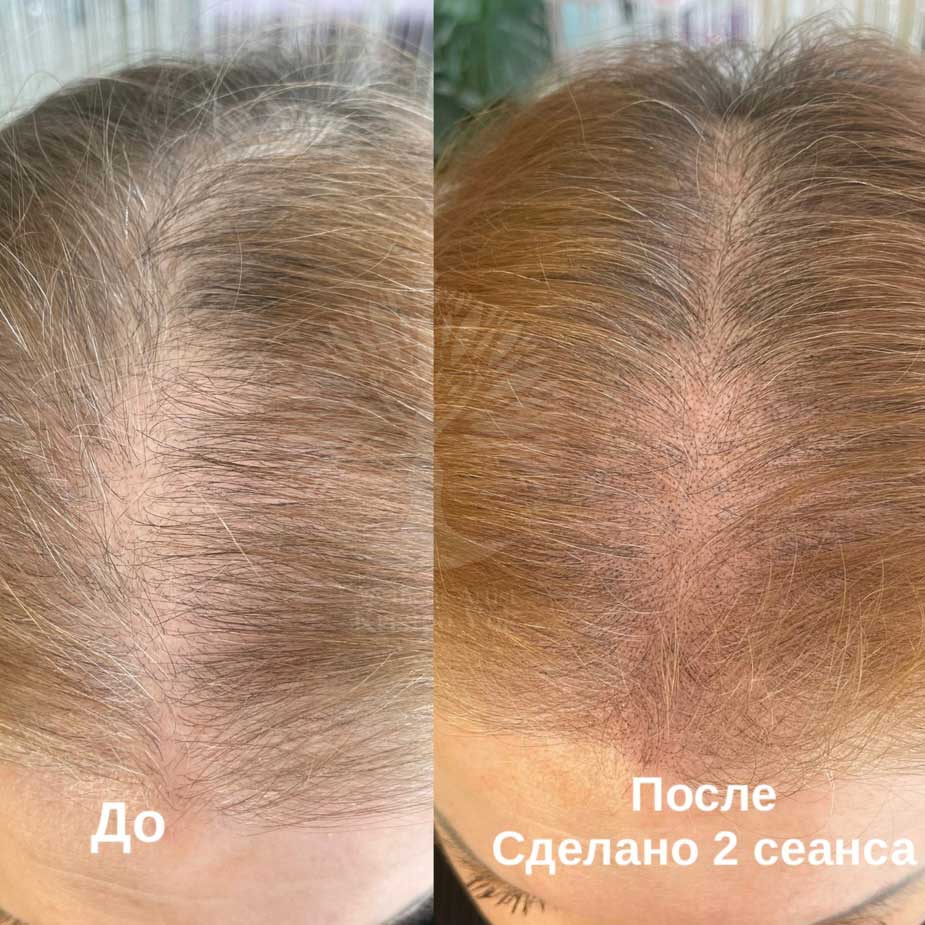 трихопигментация волос в Минске