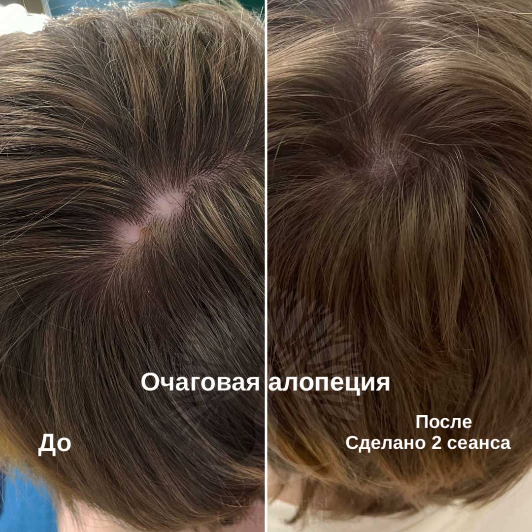 трихопигментация волос в Минске